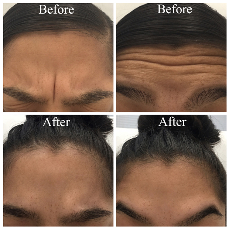  Botox – Forehead, Frown Lines & Crow’s Feet 