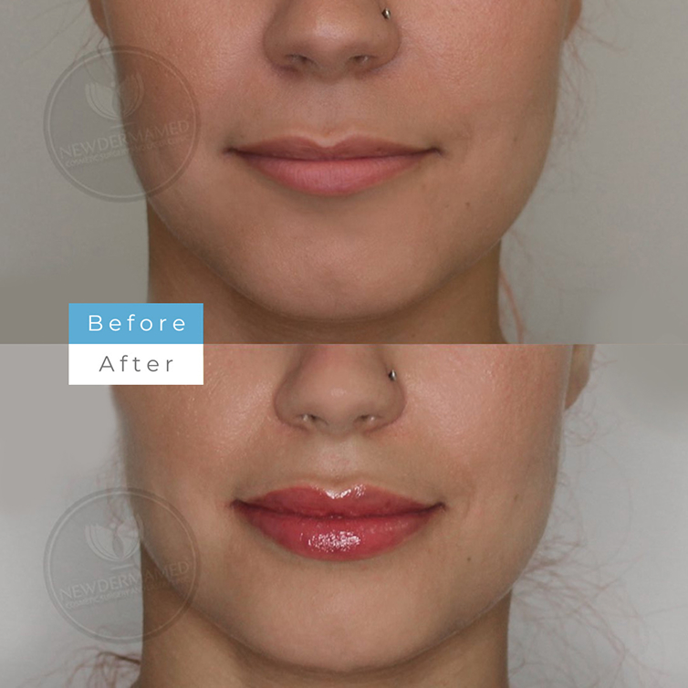 Lip Augmentation – Side Profile Results