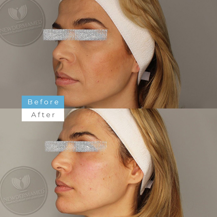  Laugh Line Filler – Smile Without the Lines
