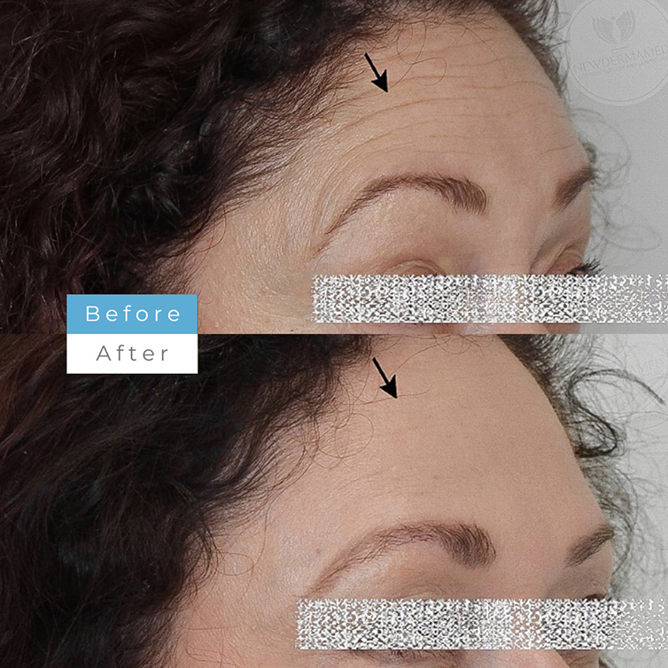 How Botox Works