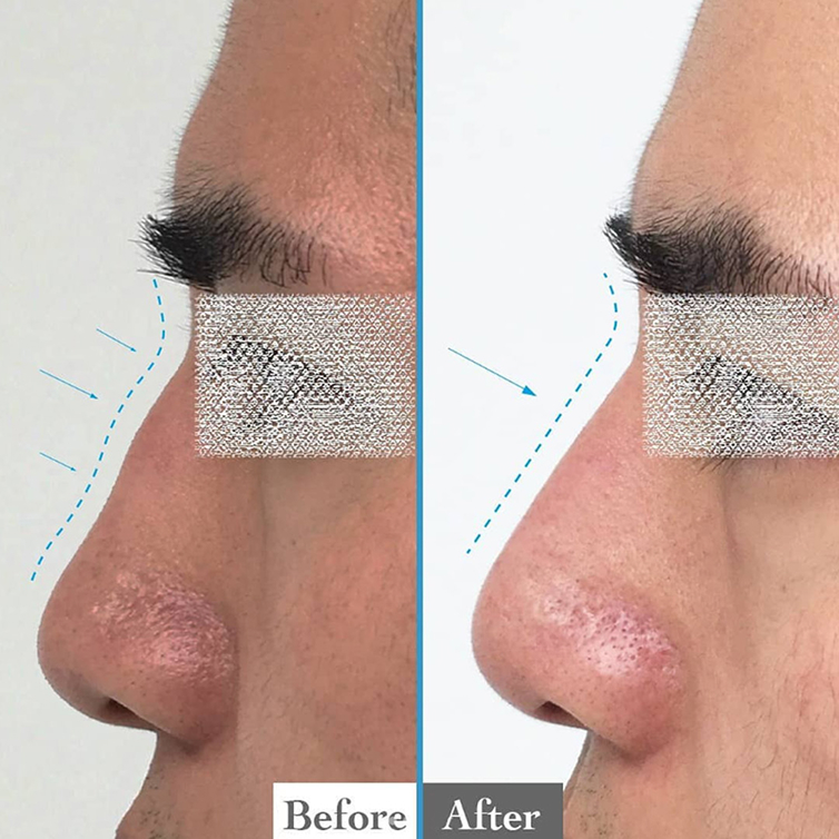 Non-Surgical Nose Job – Reshape Without Surgery