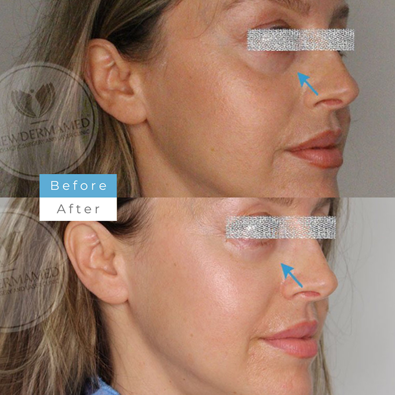 Eyelid Surgery – Brighter, Refreshed Eyes