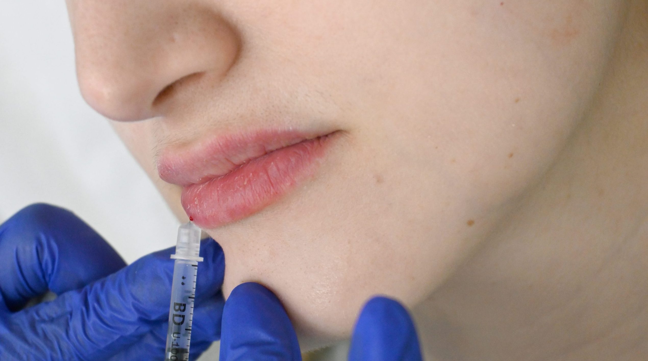 How to Choose the Right Dermal Filler