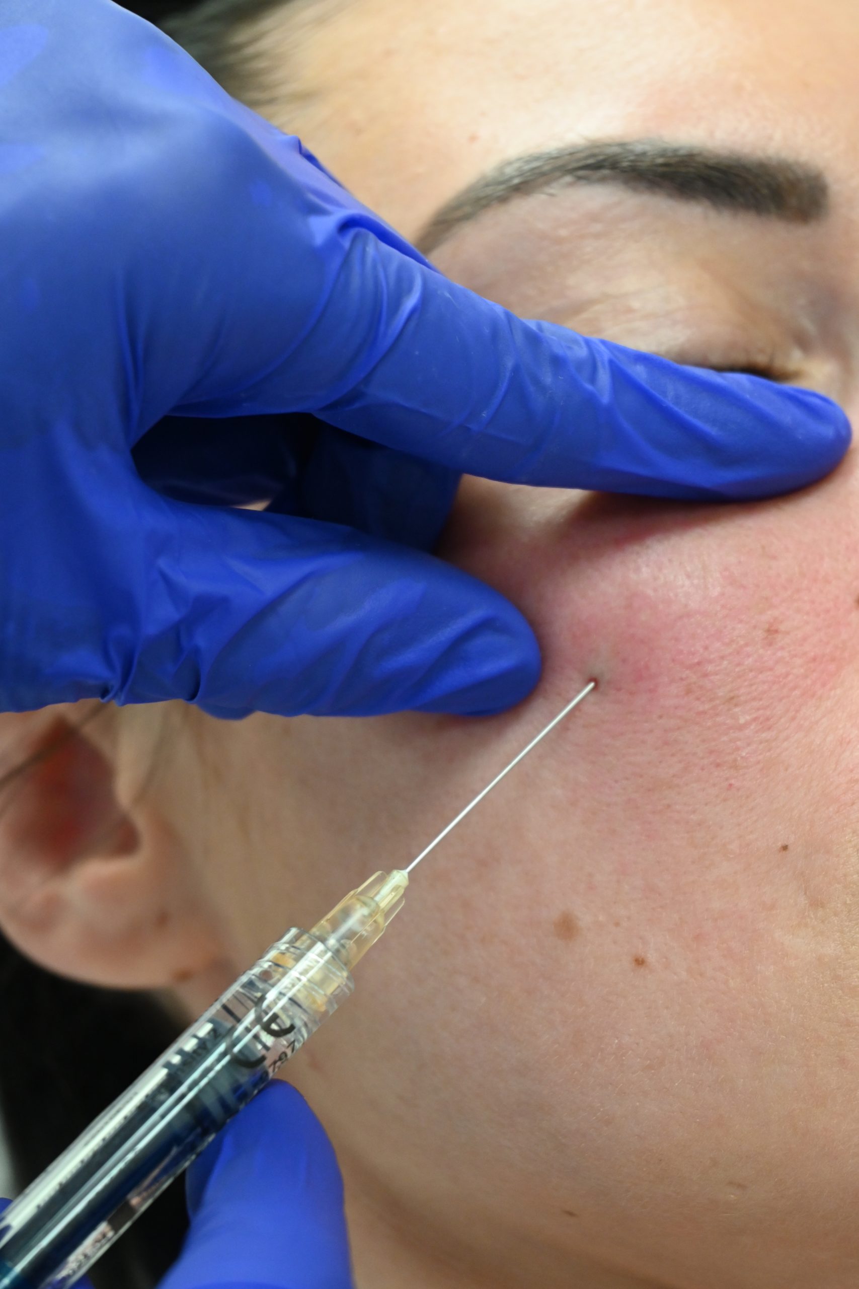 What Are Dermal Fillers?