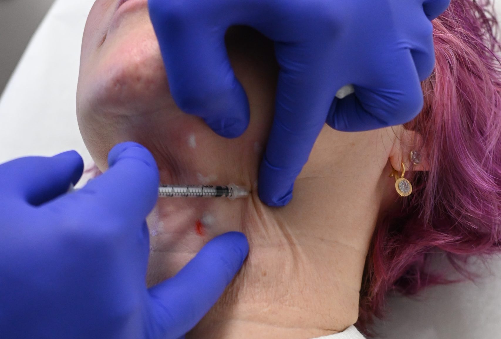 What to Expect from Botox®