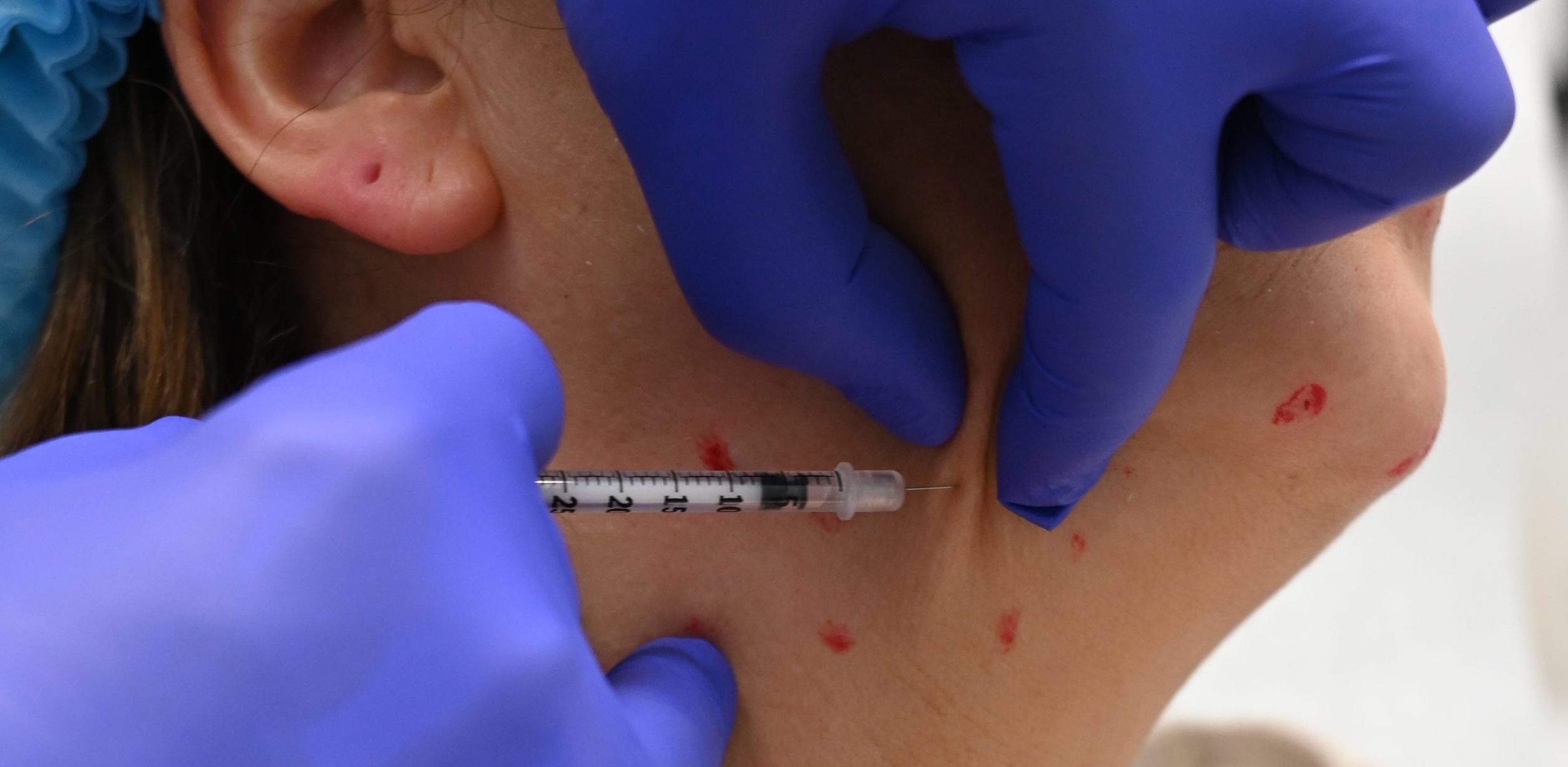 Who is a Good Candidate for Botox®?