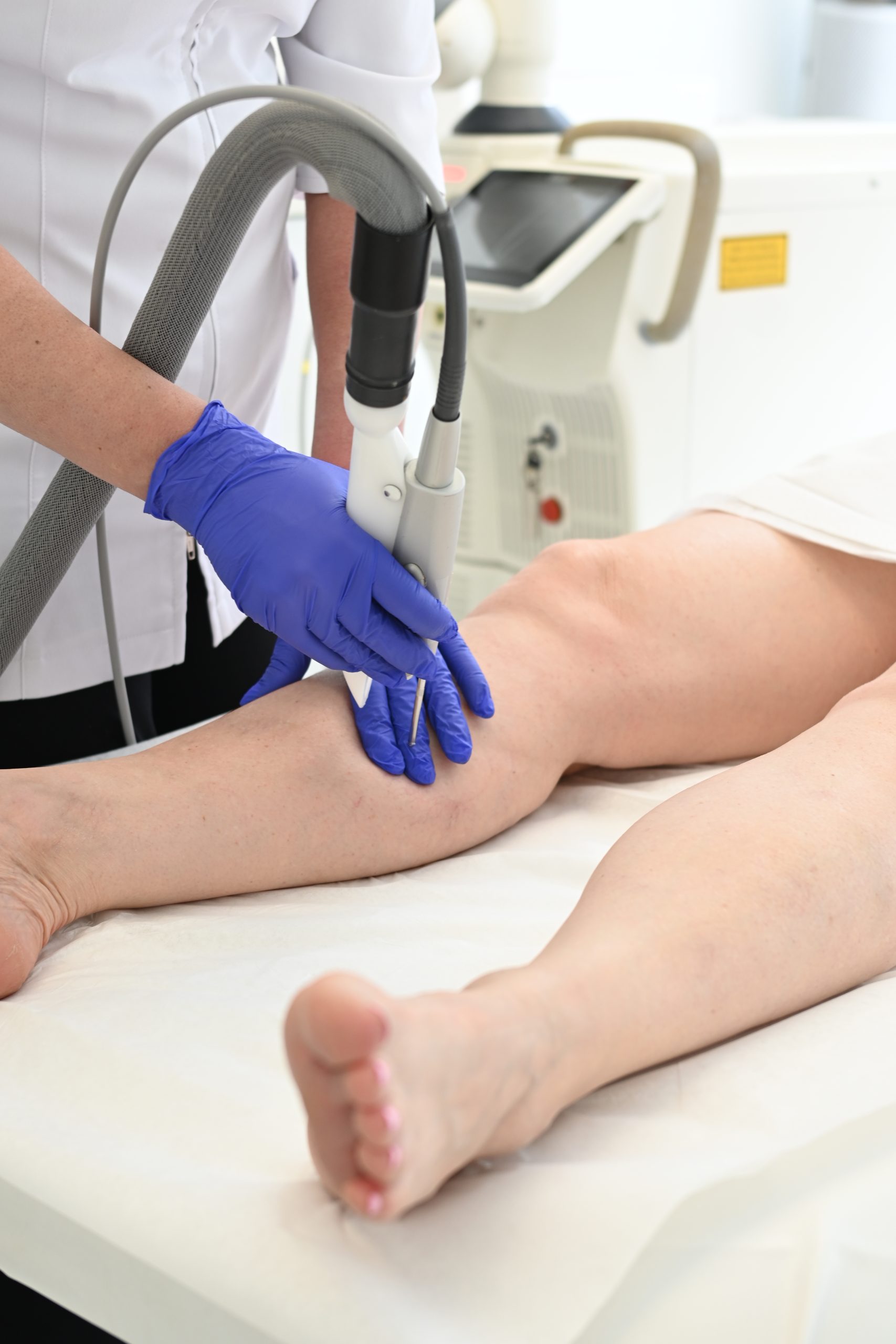 Vein Removal Toronto | Safe, Effective Solutions for Spider & Varicose Veins
