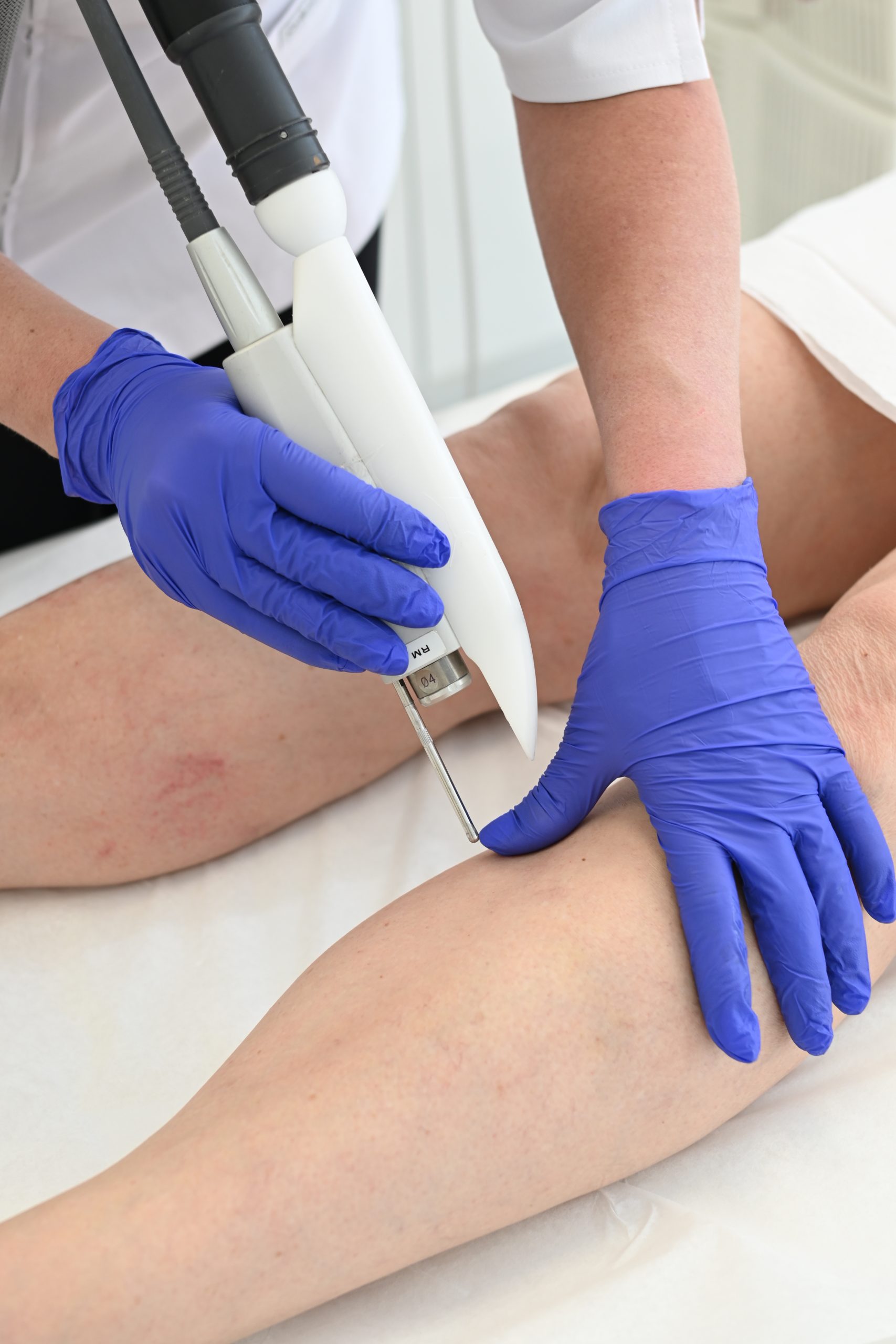 Vein Removal Toronto | Safe, Effective Solutions for Spider & Varicose Veins