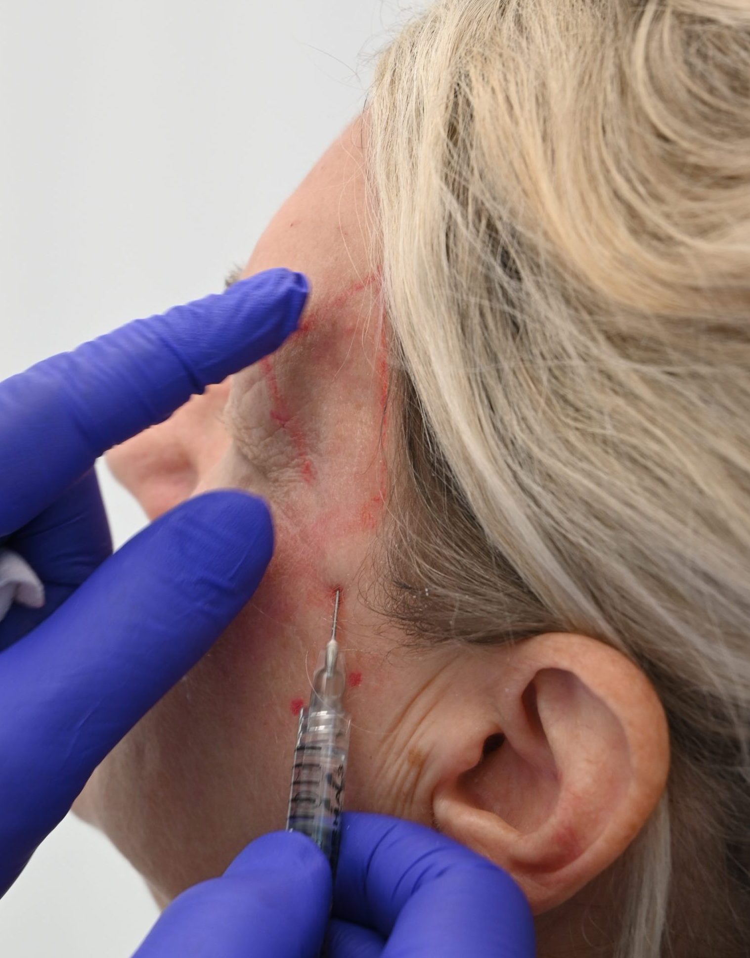 Where Are Dermal Fillers Injected?