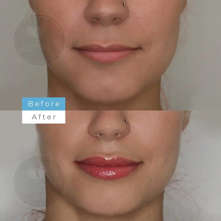 Lip Augmentation – Side Profile Results