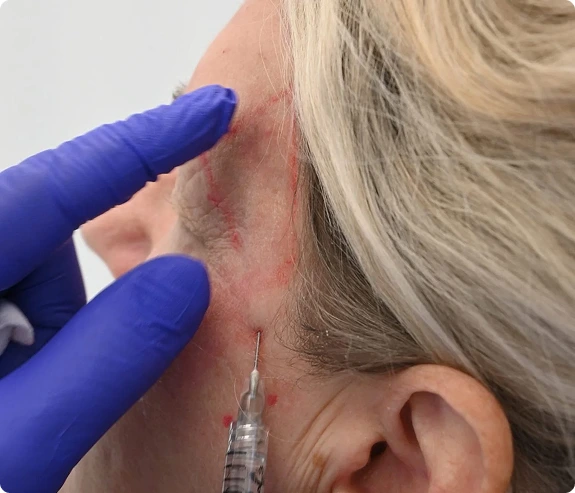 Where Are Dermal Fillers Injected?