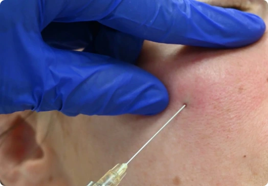 What Are Dermal Fillers?