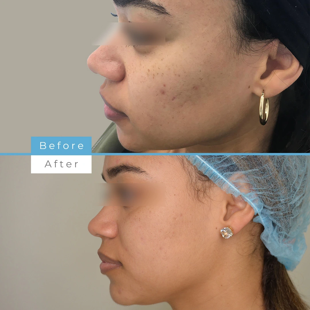 Microneedling