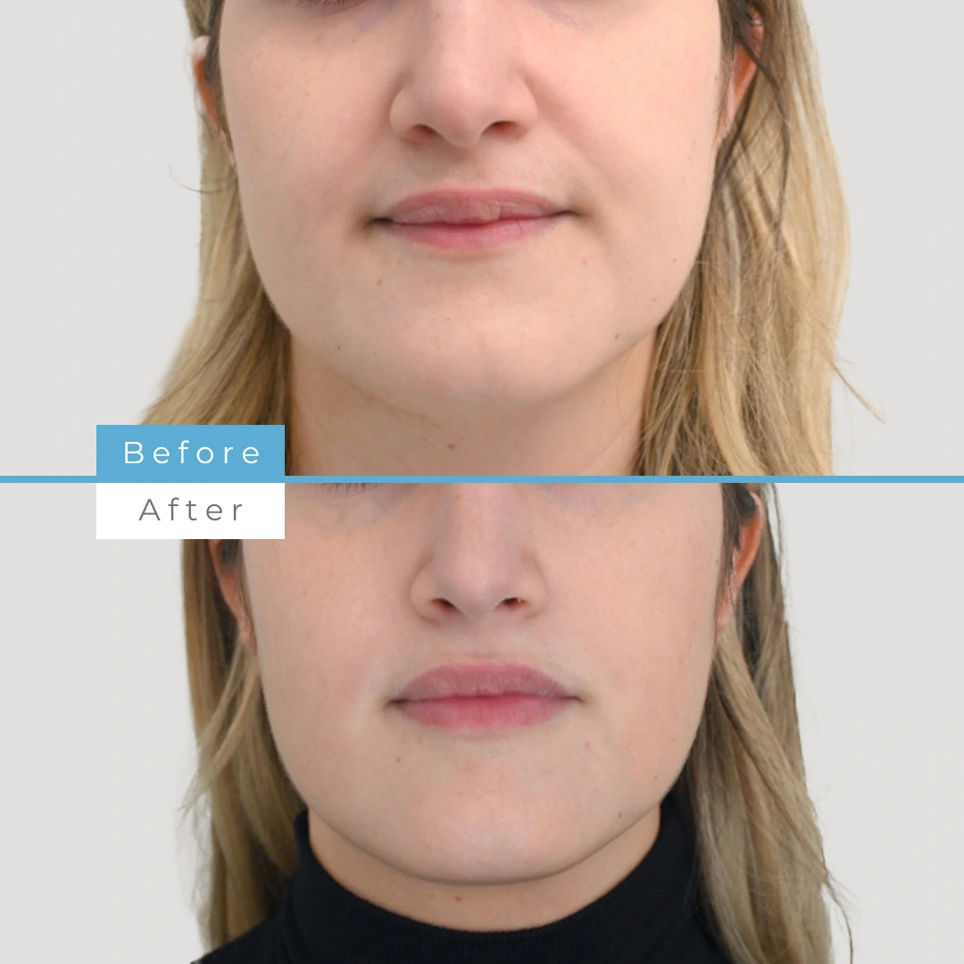 Dermal Fillers