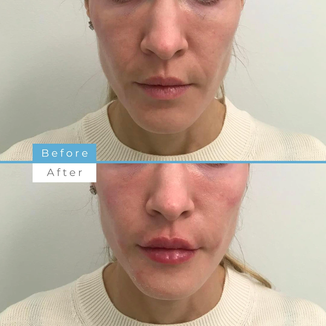 Dermal Filler full face