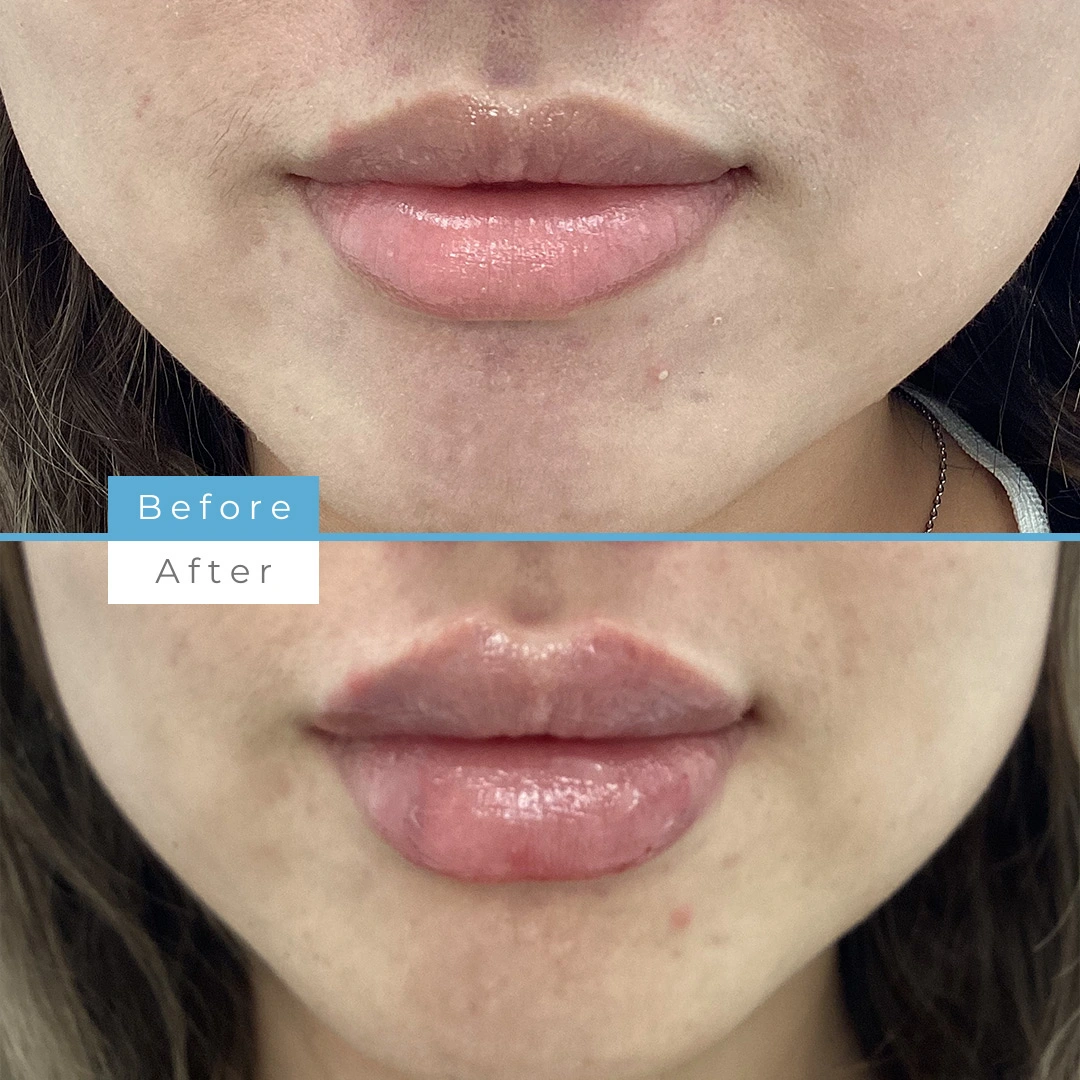  Lip fillers