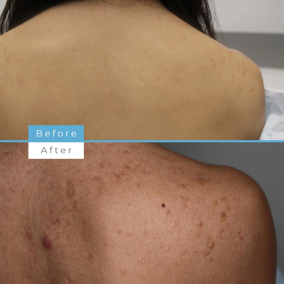  Fractional skin resurfacing.