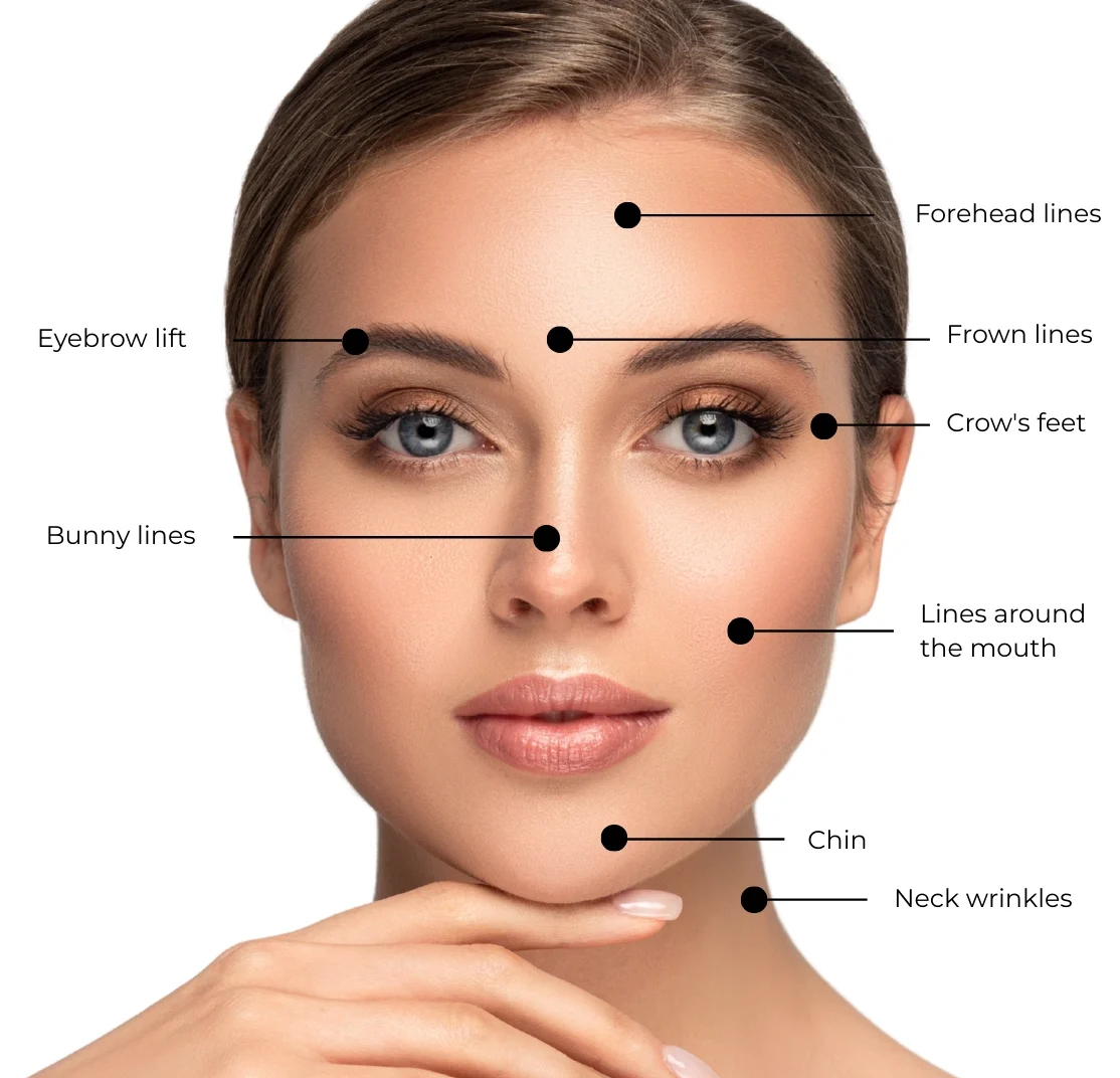 Botox® Treatment Areas