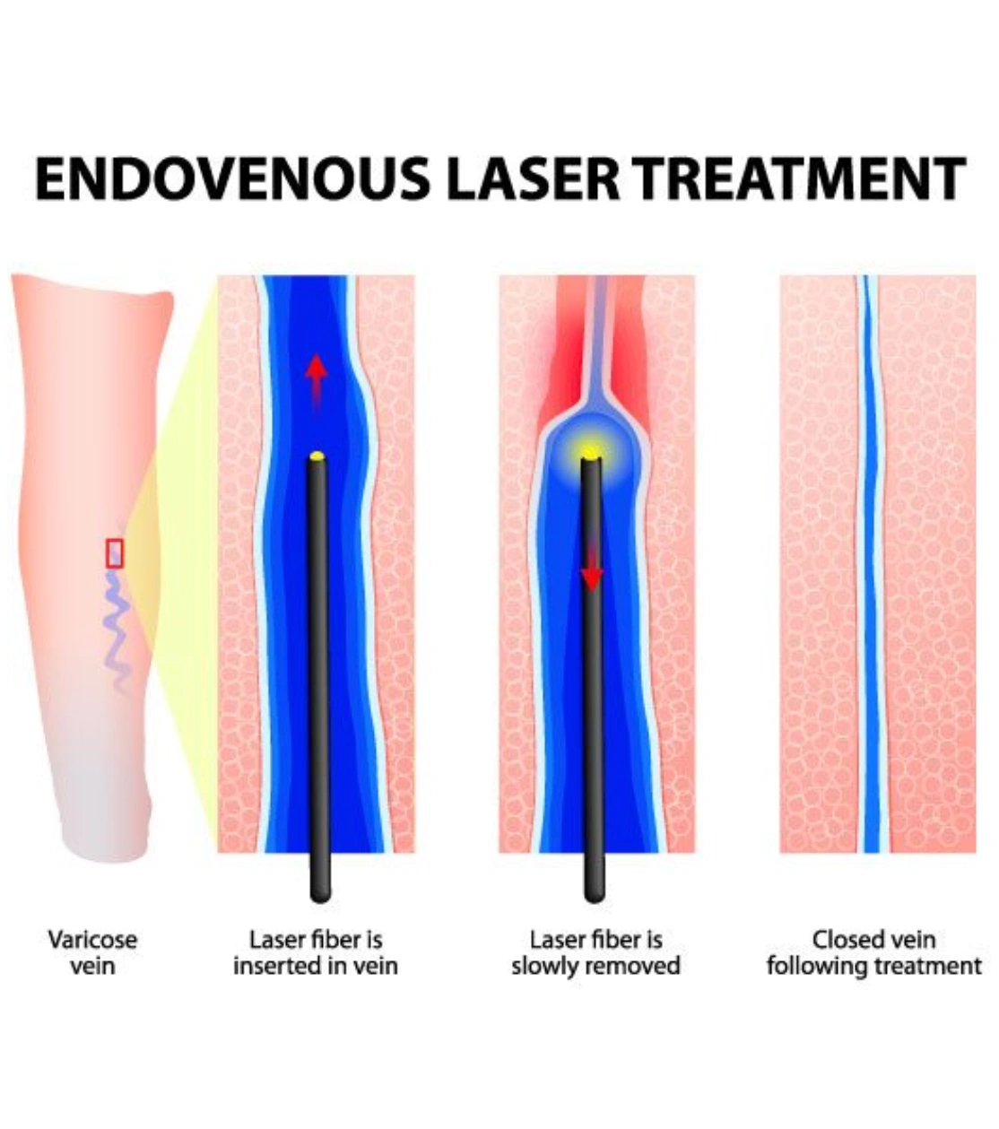 Benefits of Endovenous Laser Treatment (ELVT)