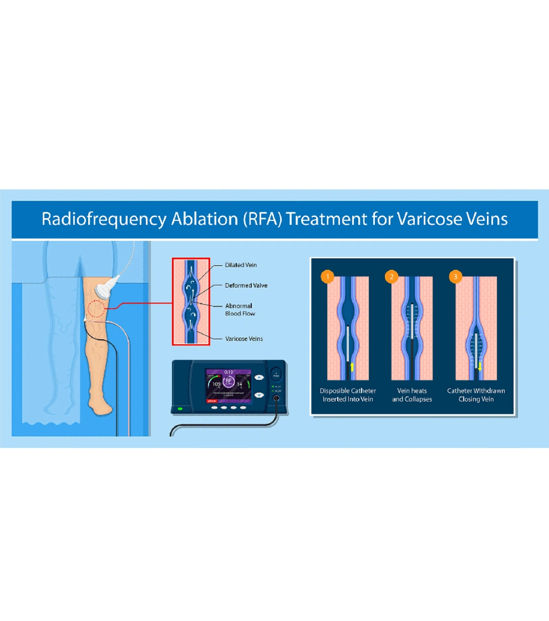 Benefits of Radiofrequency treatment