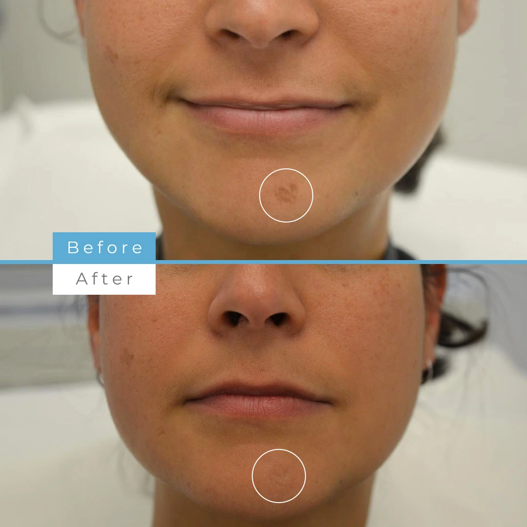 Fractional skin resurfacing