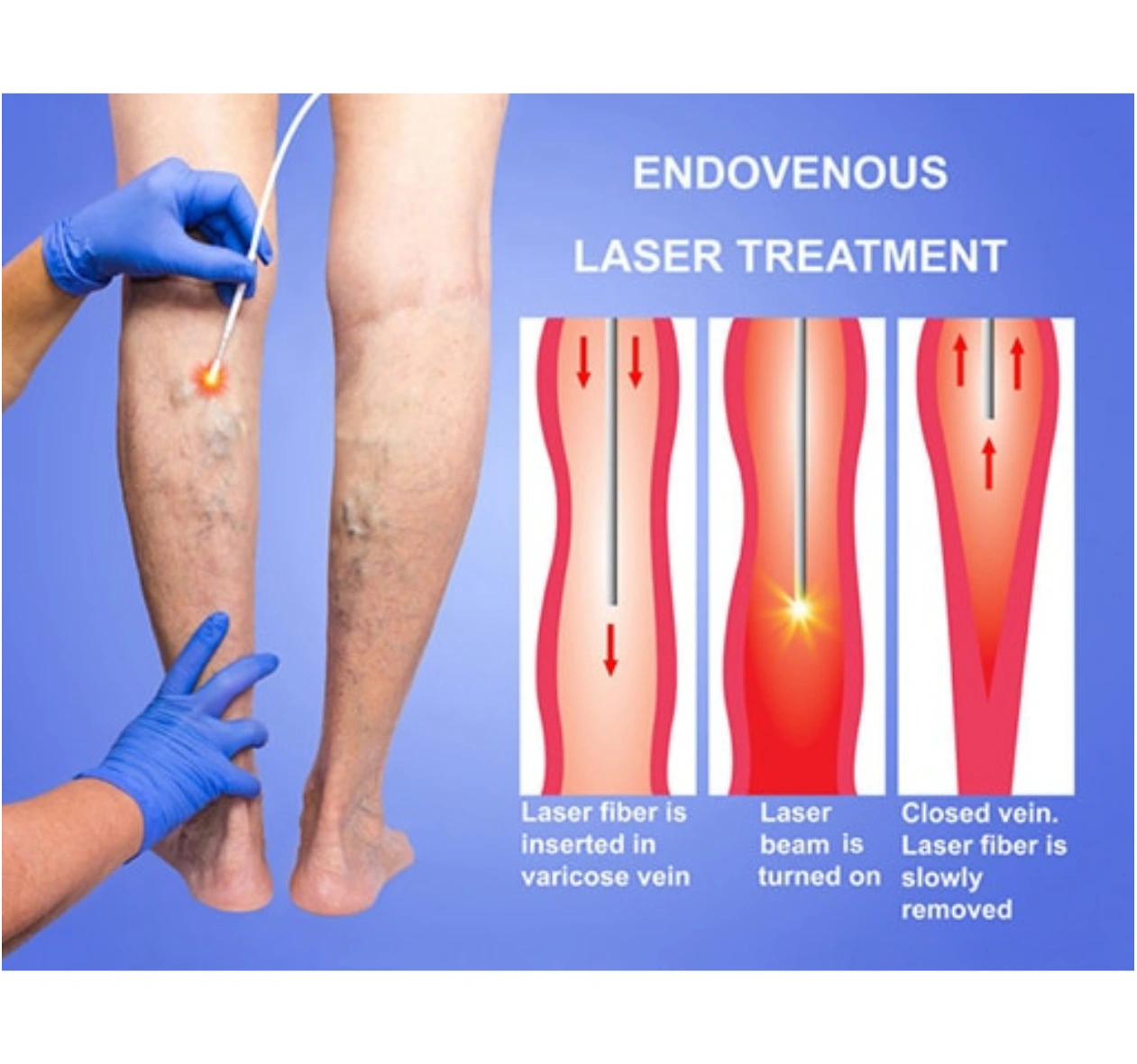 What to expect of the ELVT Procedure?