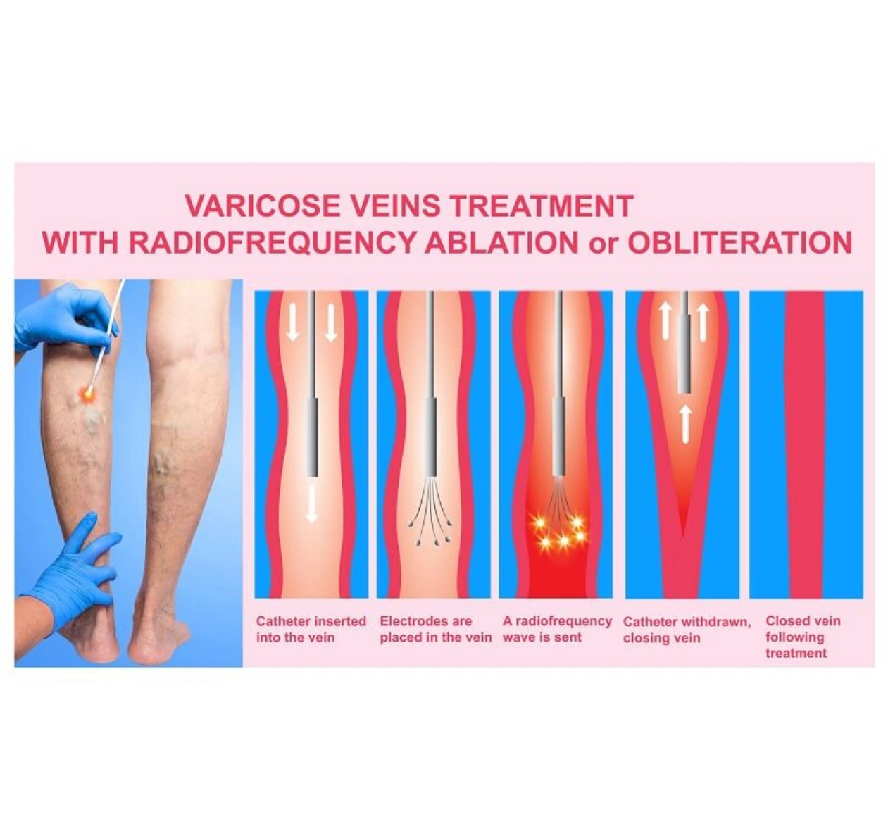 Why must you wear compression stockings post treatment?