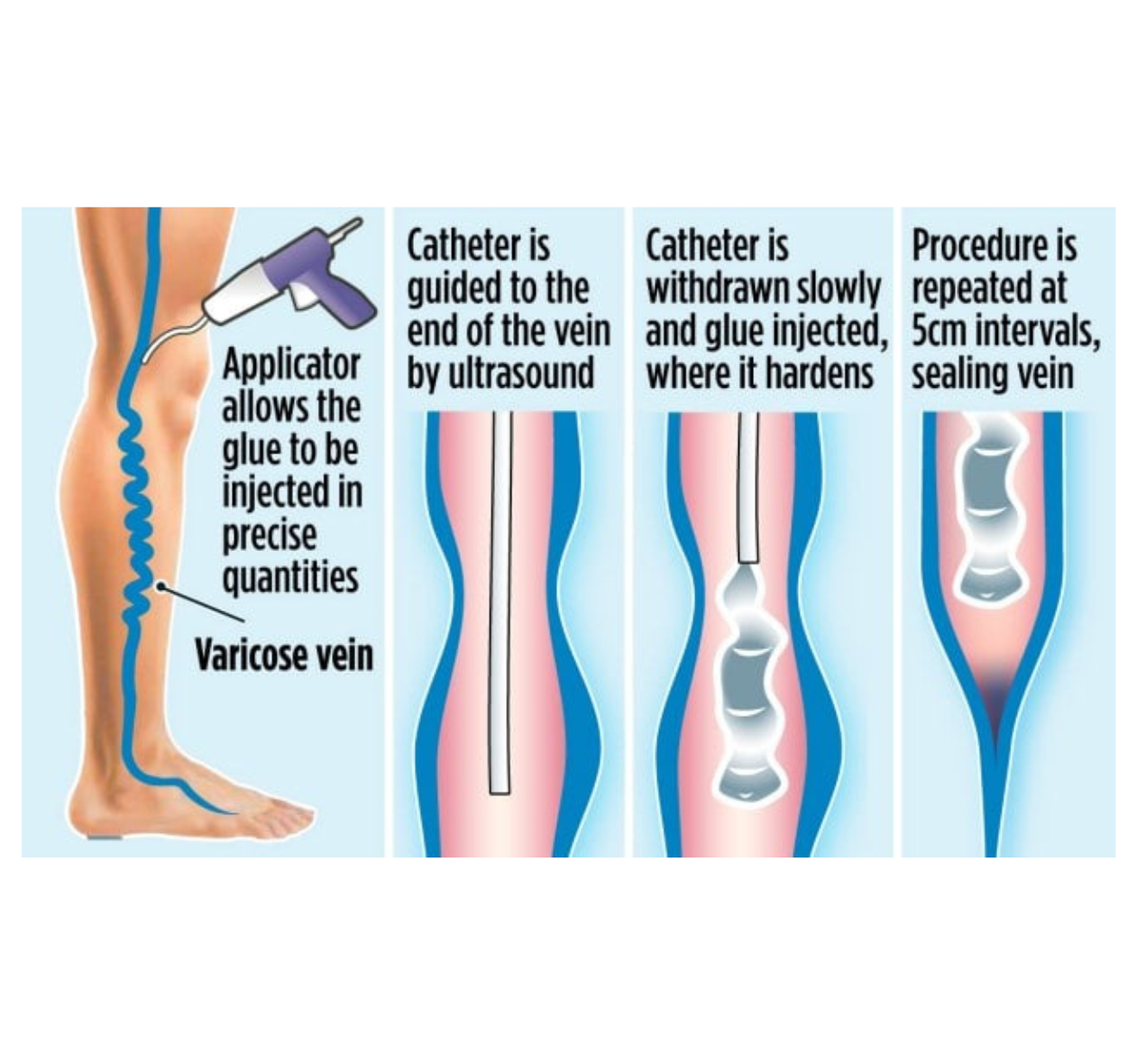 How VenaSeal™ Works