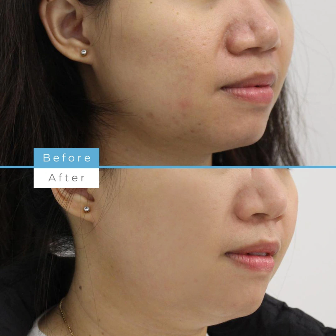 Fractional skin resurfacing