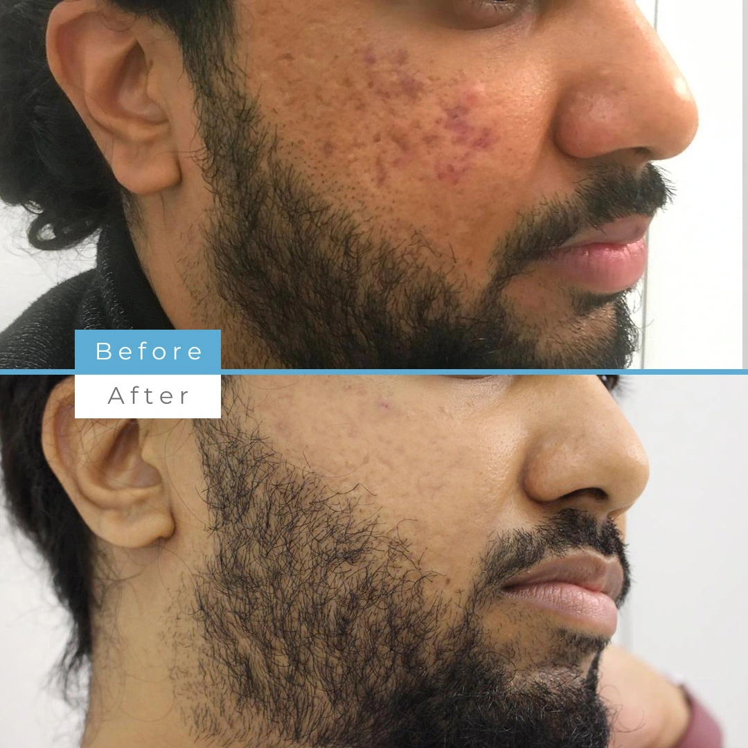 Fractional skin resurfacing