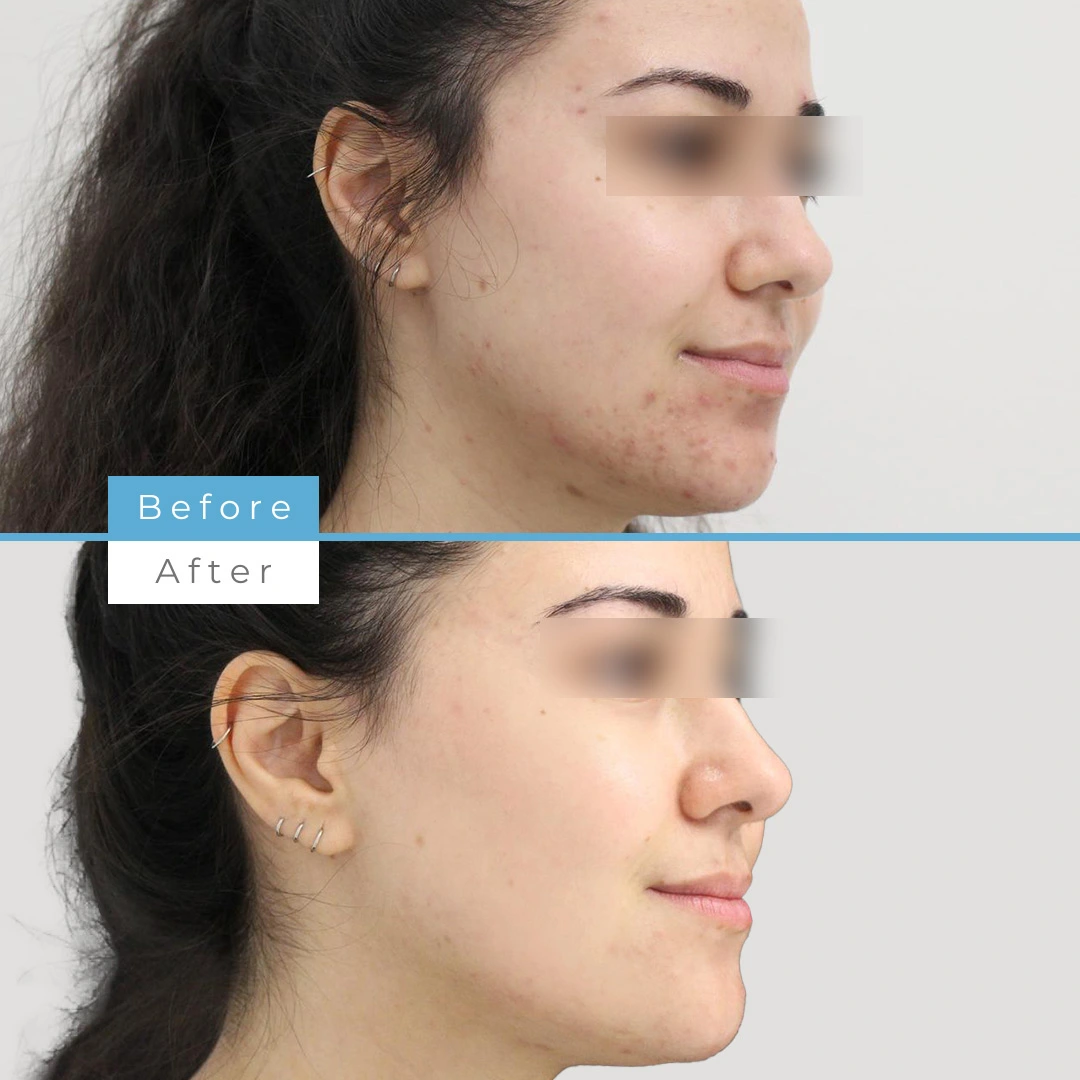 Laser Acne