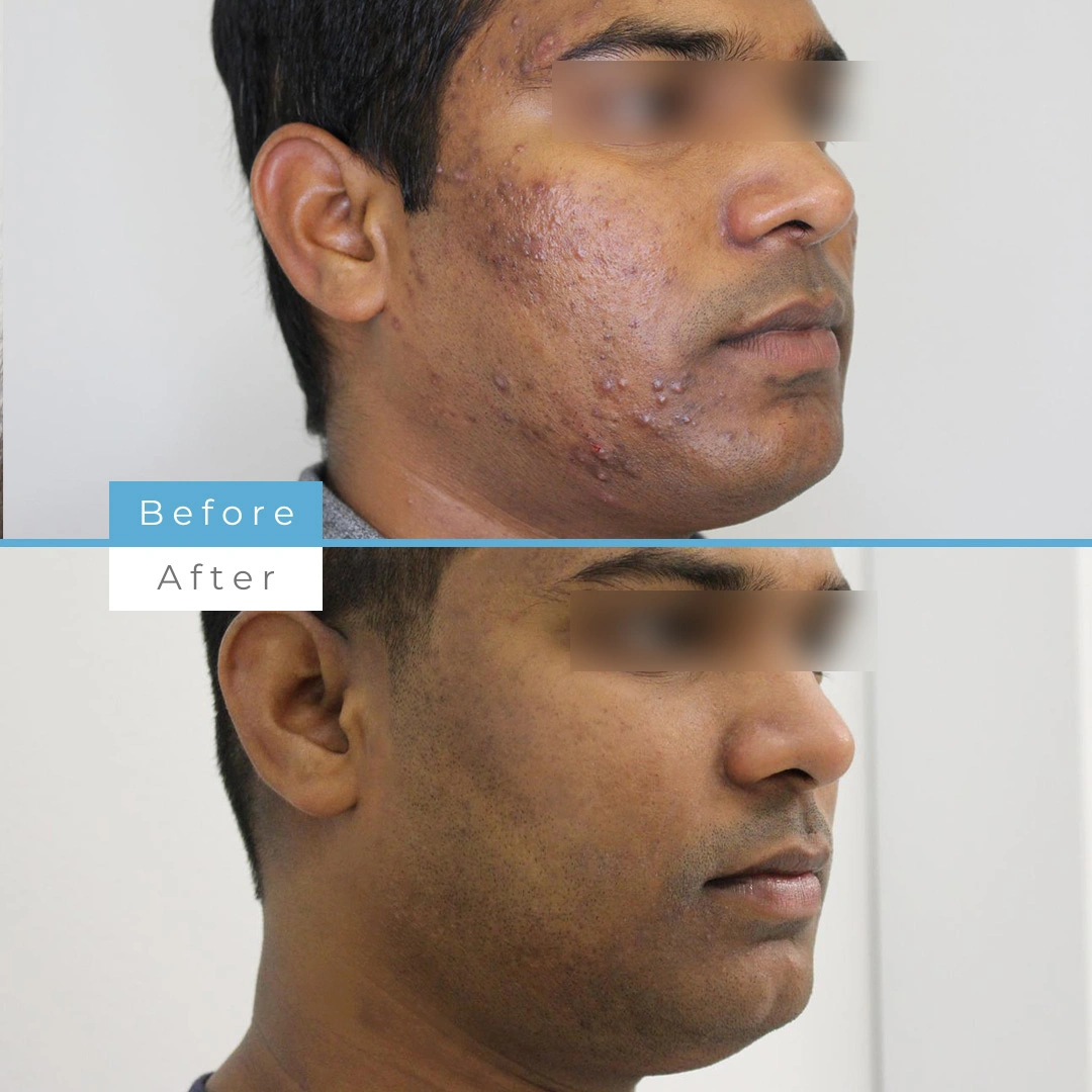 Laser Acne