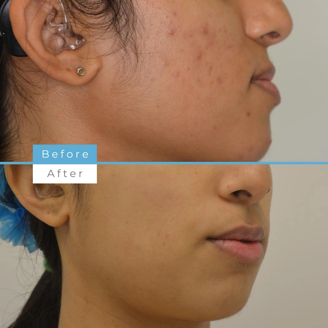 Laser Acne