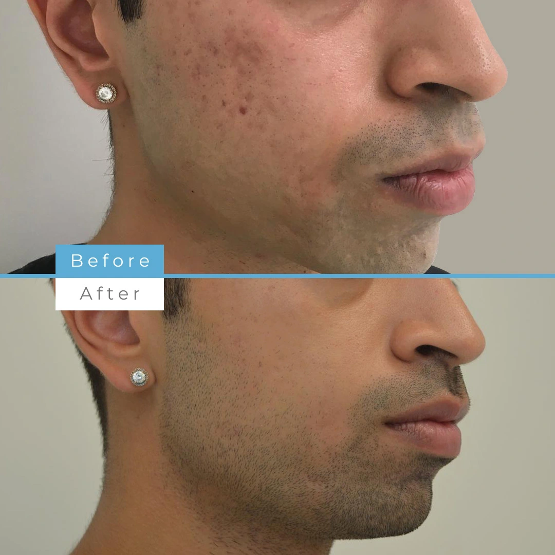 Fractional skin resurfacing_ acne scarring