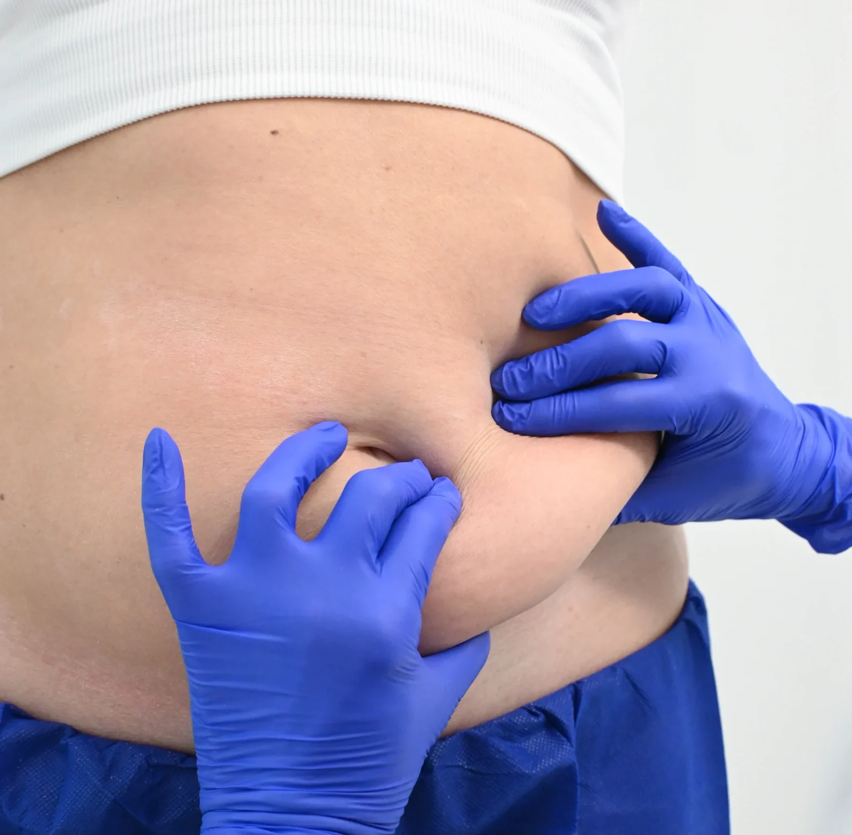 What is CoolSculpting?