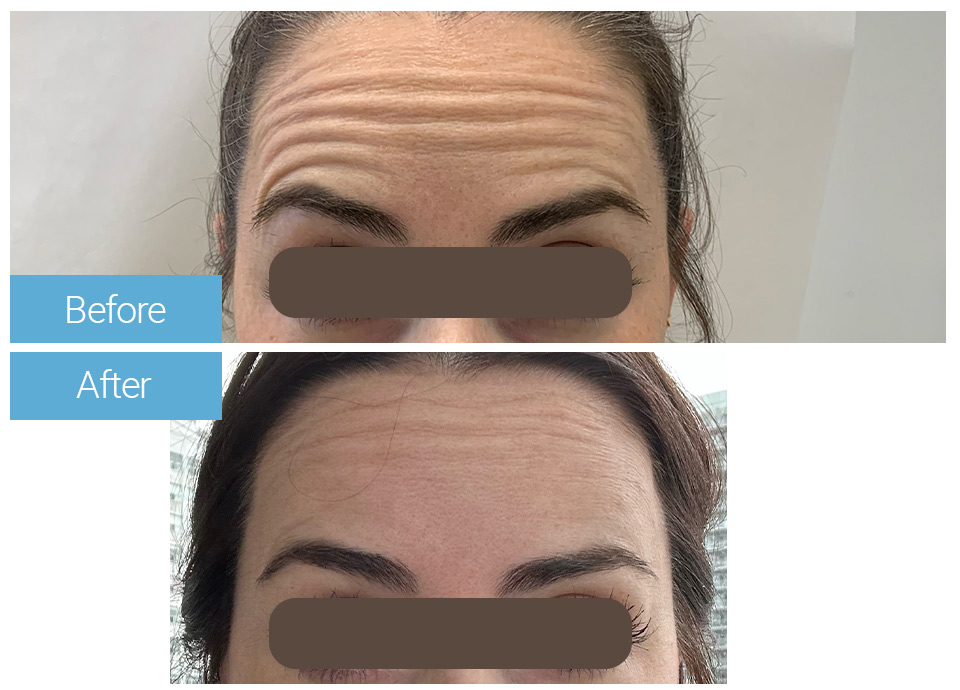 Botox