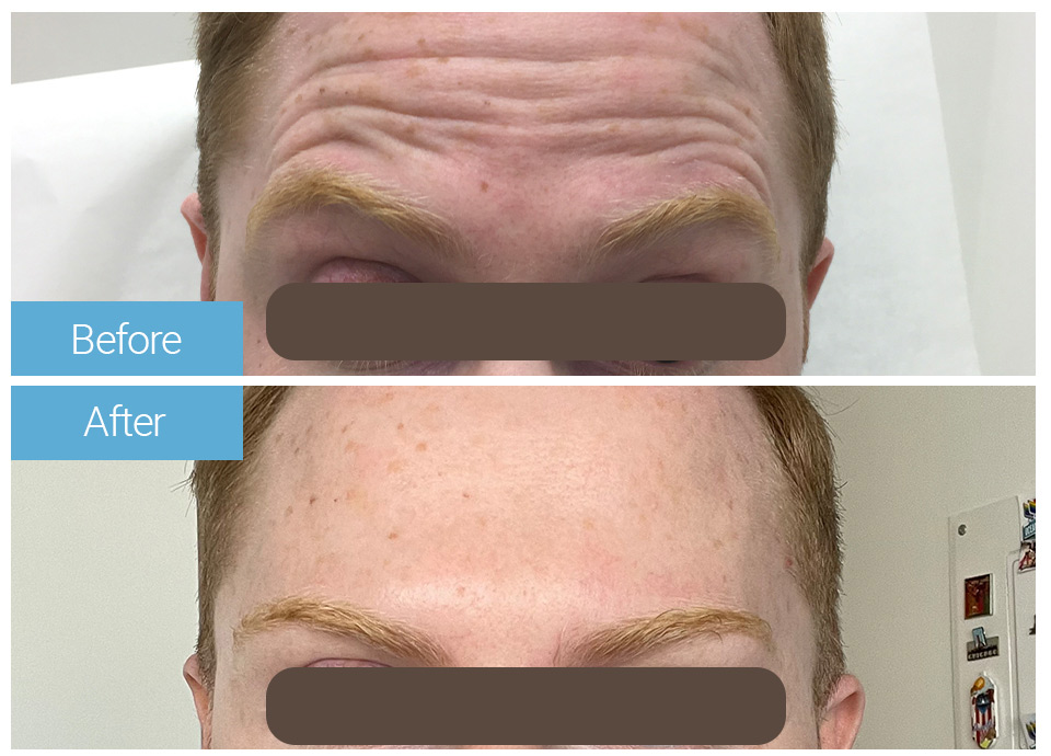 Botox