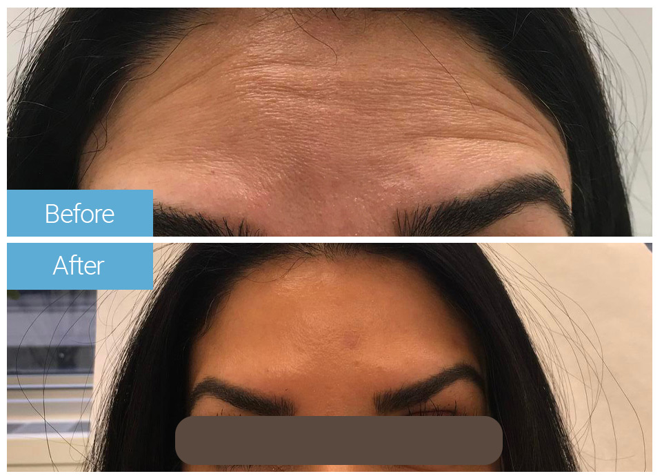 Botox