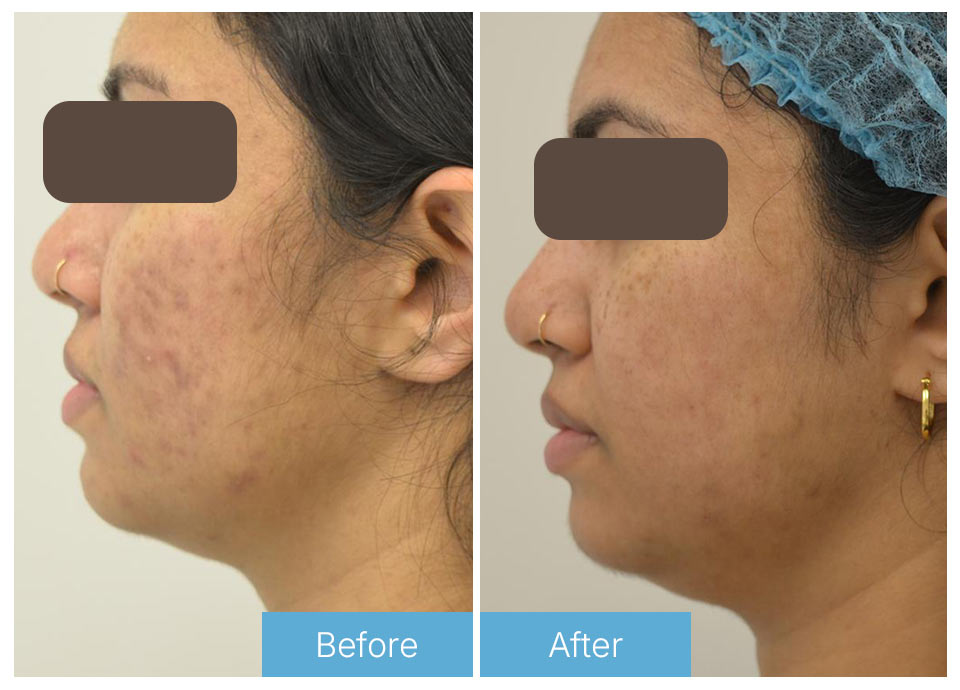 Chemical peel