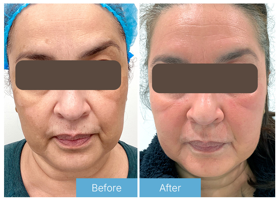 Chemical peel