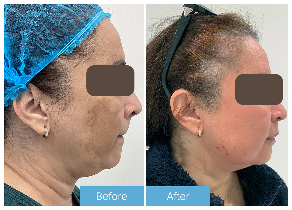Chemical peel