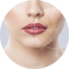 Fractional skin resurfacing