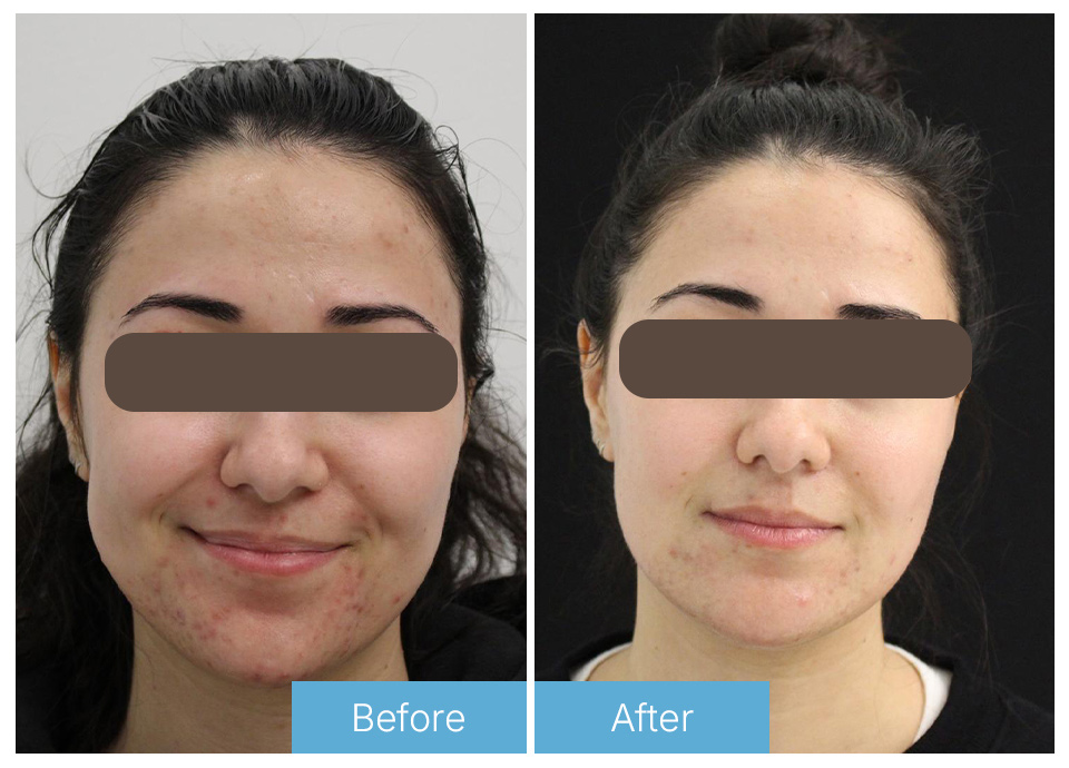 Laser acne 