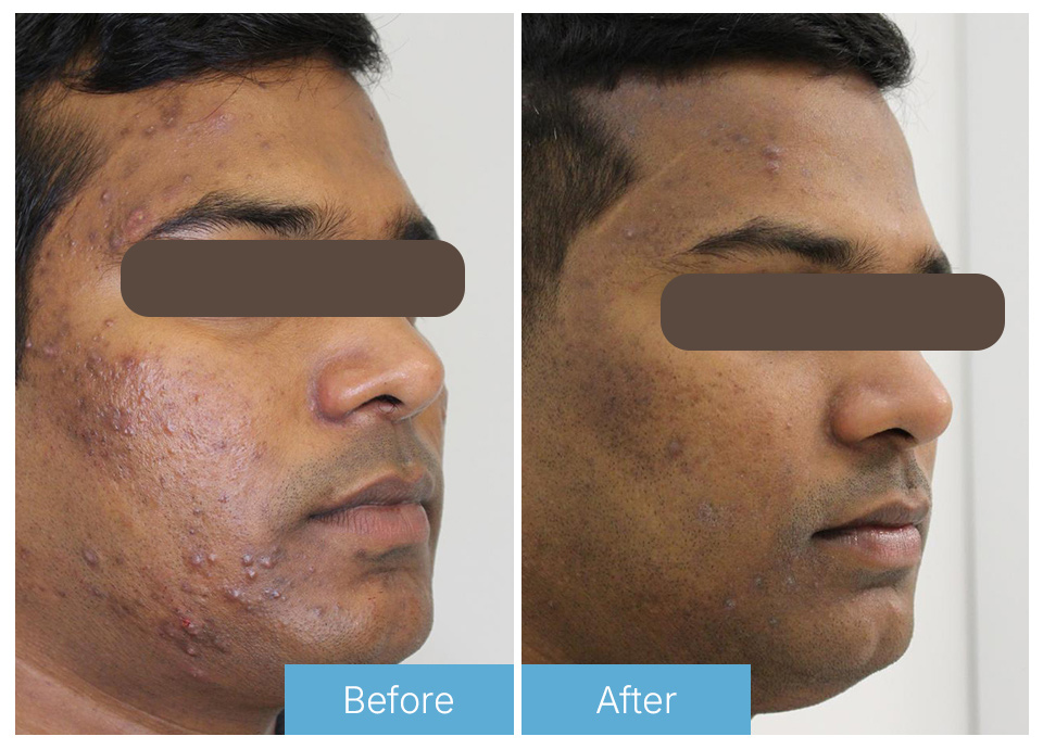 Laser acne 
