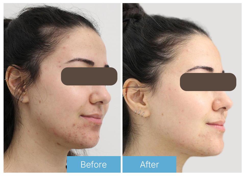 Laser acne 