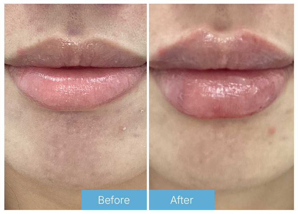 Lip fillers
