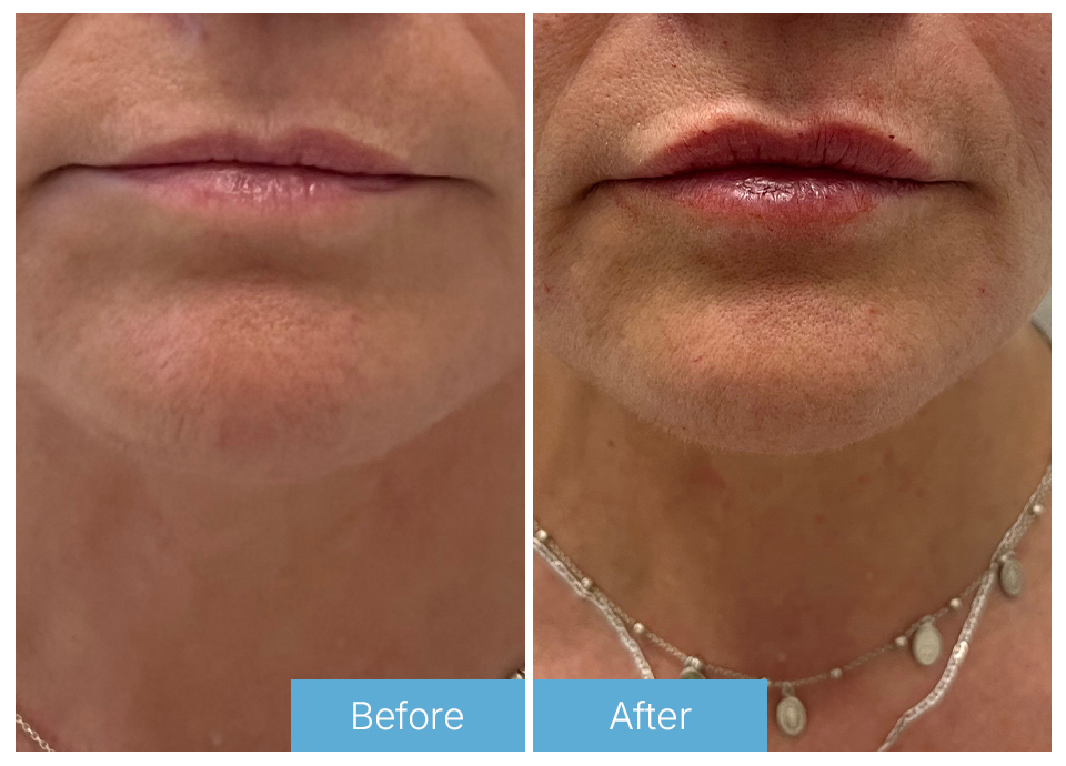 Lip fillers