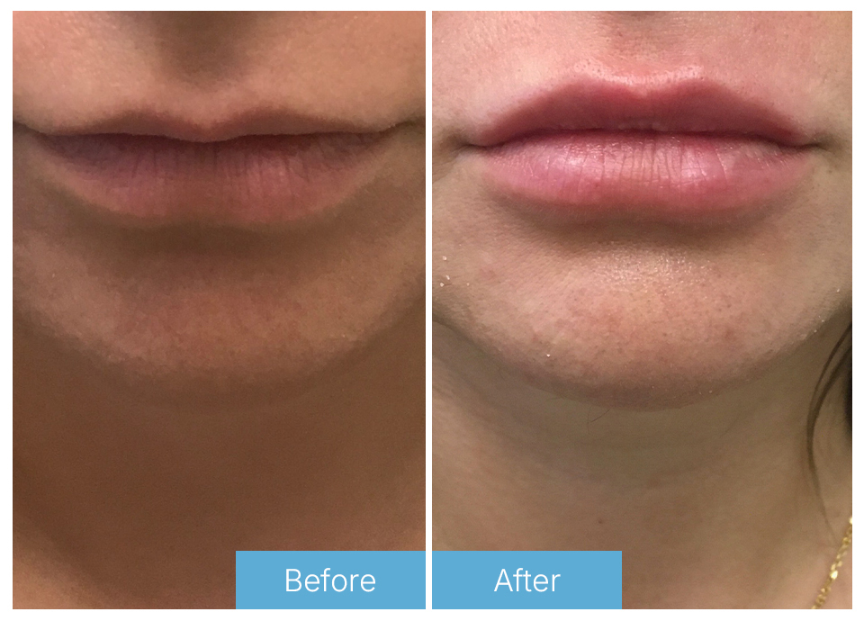 Lip fillers