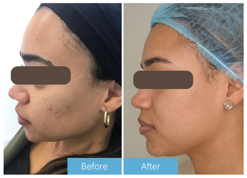 Microneedling