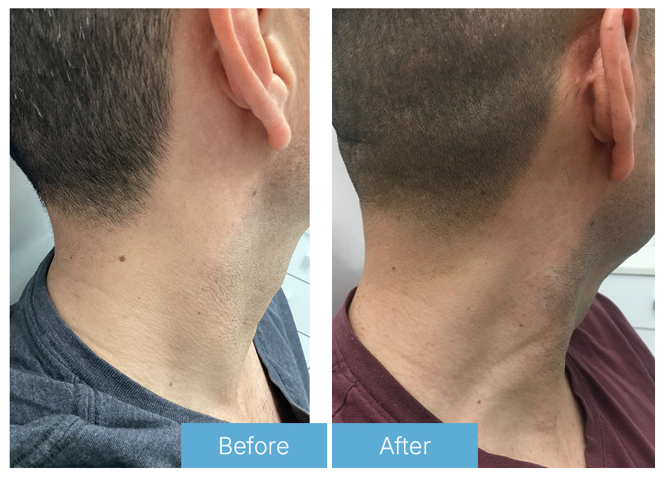 Mole removal